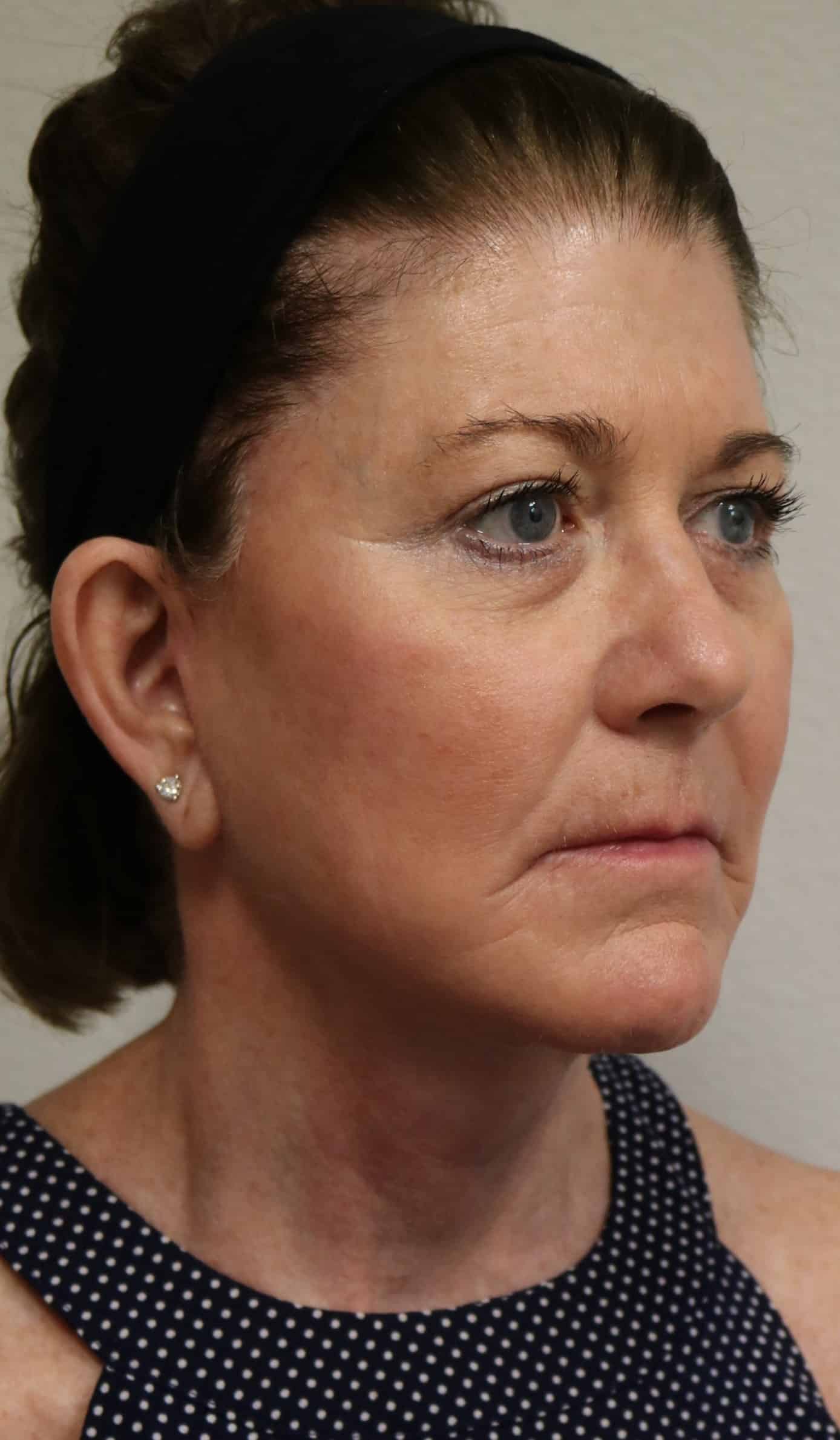 After Image: Facelift - right-front-oblique