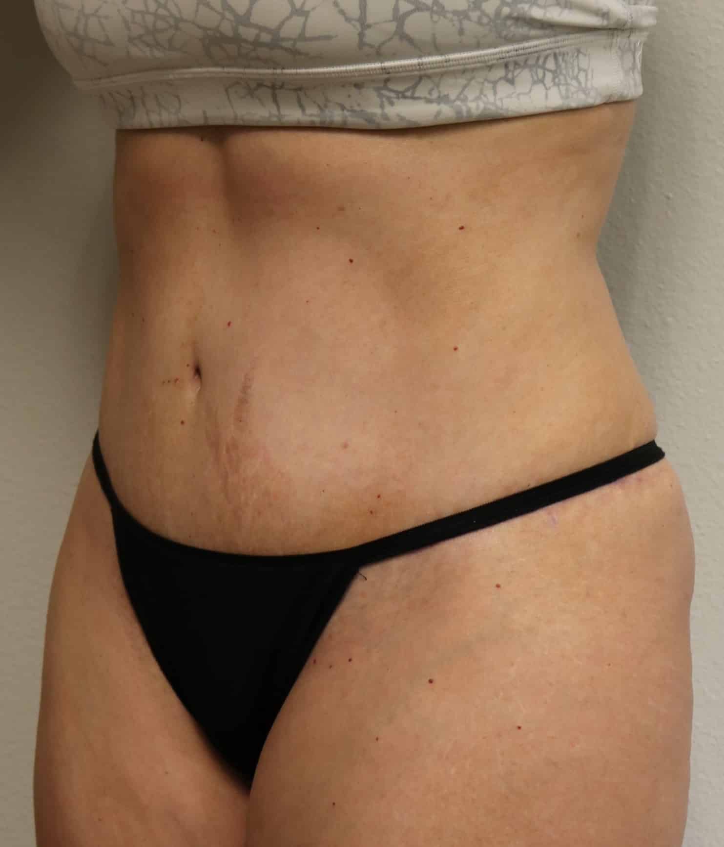 After Image: Abdominoplasty - left-front-oblique