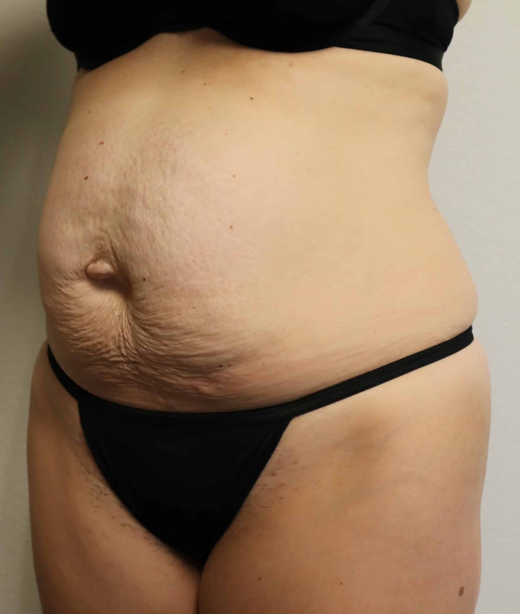 Before Image: Abdominoplasty - left-front-oblique