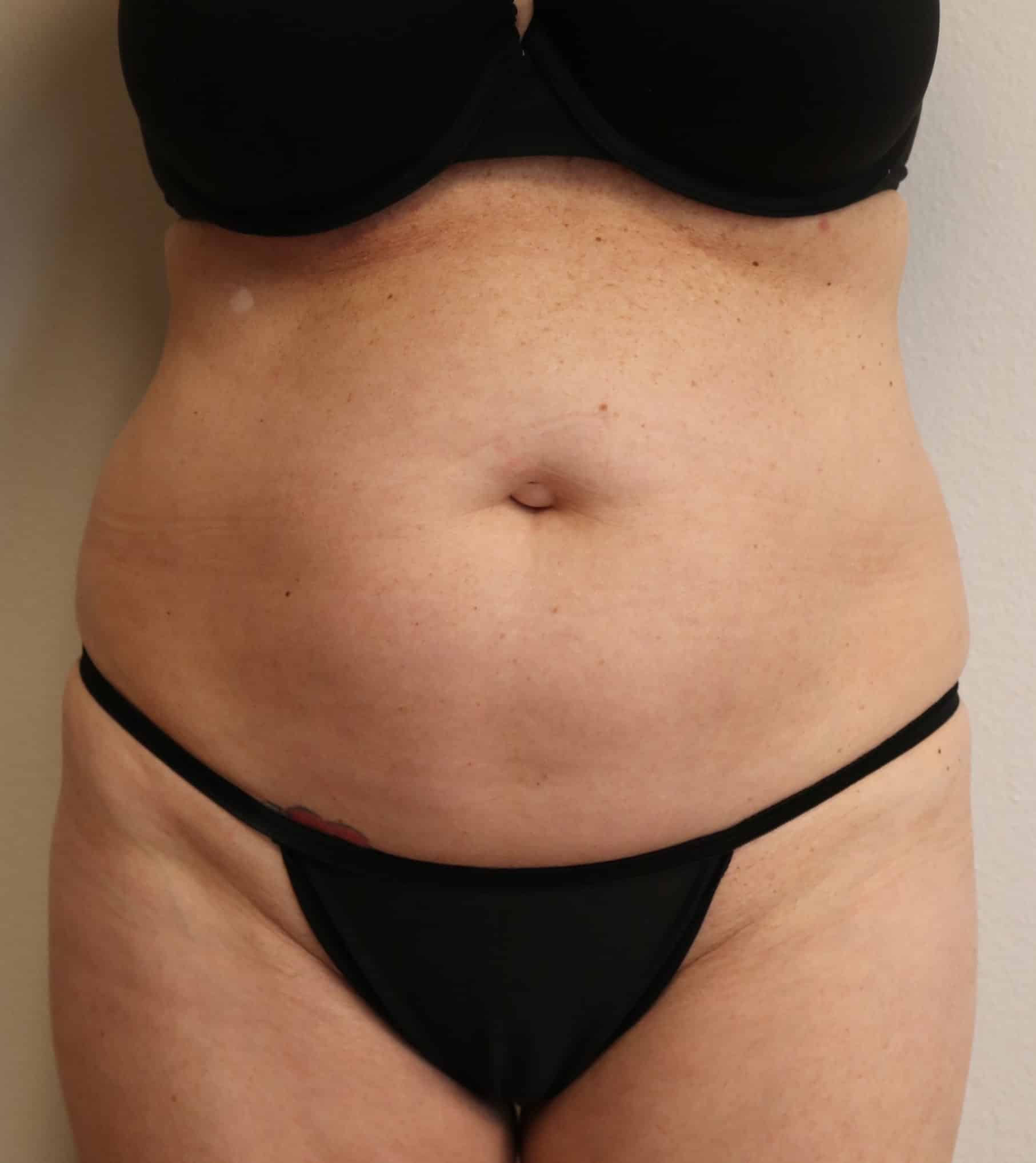 Before Image: Liposuction - front