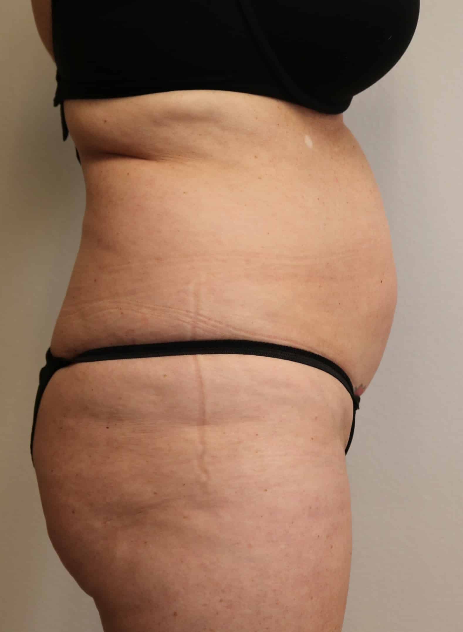 Before Image: Liposuction - right-side