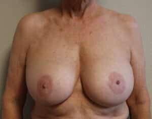 Breast Implant Removal