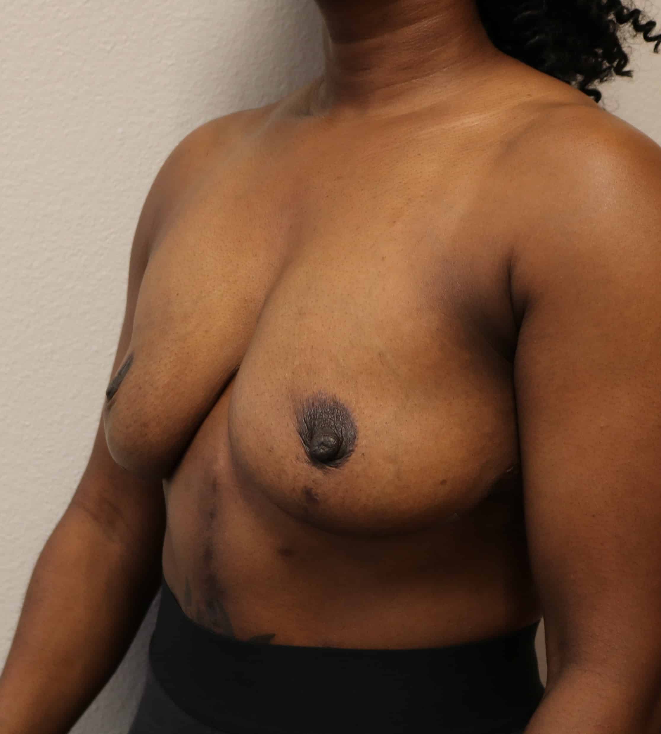After Image: Breast Implant Removal - left-front-oblique