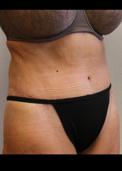 Supplies for Body Contour Surgery: Abdominoplasty, Body Lift, Liposuction